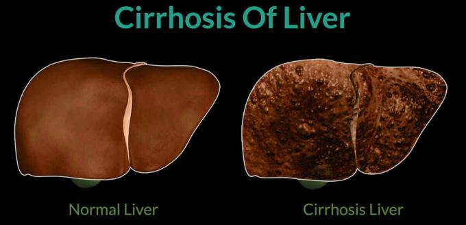 On the left - a healthy body, the right - liver cirrhosis 