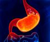 Do I need a diet for reflux?