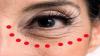 How to erase wrinkles around the eyes