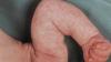 "Marble" skin in babies: norm or pathology? Neurologist answers