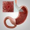 Gastritis, or erosion of the stomach: the main symptoms, treatment, diet