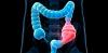 These factors and early signs of colorectal cancer
