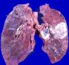 Lung cancer: how not to miss the start of the disease?