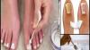 How to get rid of nail fungus by means of soda and garlic