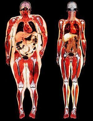 Left - just visceral obesity. All organs smothered with fat.