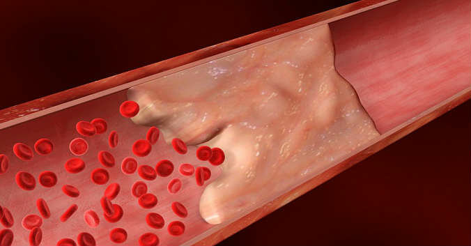 Arterial blockage