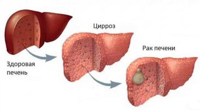 Liver cancer