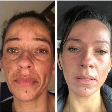 To understand the effect of retinol and retinoids, just look at this example: pigmentation in almost all areas of the face was gone, the skin became much fresher and generally shows that the younger man