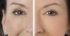 How to remove wrinkles around the eyes at home