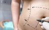 Most Popular Liposuction Myths