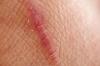 Scars on the skin: what it is and how to remove them