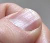 Protruding nails: what does this mean?