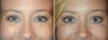 What combination of cosmetic procedures will bombichesky effect for your face