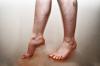 Violation of blood flow in the legs: Causes, Symptoms