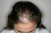Baldness in women. Parse question about AGA and which drugs are advised trichologists