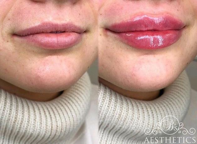 Vertical asymmetry: the upper lip is thin and almost horizontal, lower - bulk and natural eversion (photo: @bsaestheticss)