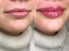 It looks like the lips after the increase correction of vertical asymmetry