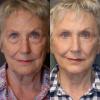 They look like mature women after lower blepharoplasty