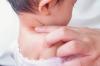 Ringworm is a child: sources of infection, symptoms and treatment
