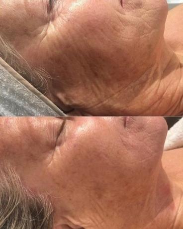 I think everything here is obvious and there is lightening, and fewer wrinkles, pigmentation and even reduced. However, it is not known what is the procedure in a row. But obviously not the full course