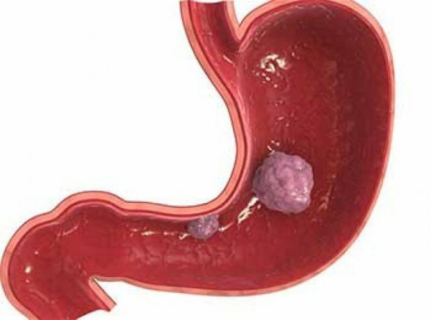 Stomach cancer 