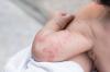 How to treat atopic dermatitis in children