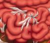 Abdominal adhesions: how to prevent the formation of