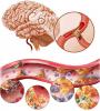 Cerebral atherosclerosis: how to treat, what are the symptoms?