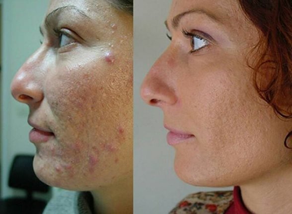 Well, about the struggle of retinol acne, I think we all know. That's as a result of