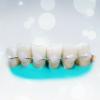 Popular splinting teeth: how much it effectively?