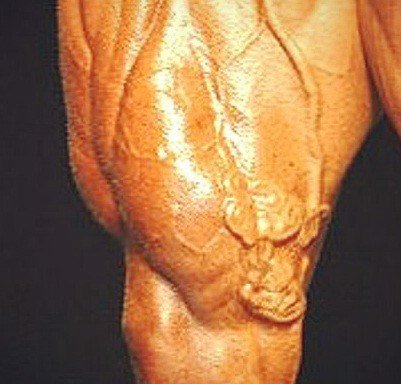 Fragment of bodybuilder legs and varicose veins. In later life all weight training will make themselves known. And in vogue for a long time CrossFit