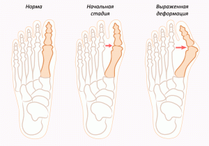 How to remove a bone in the foot