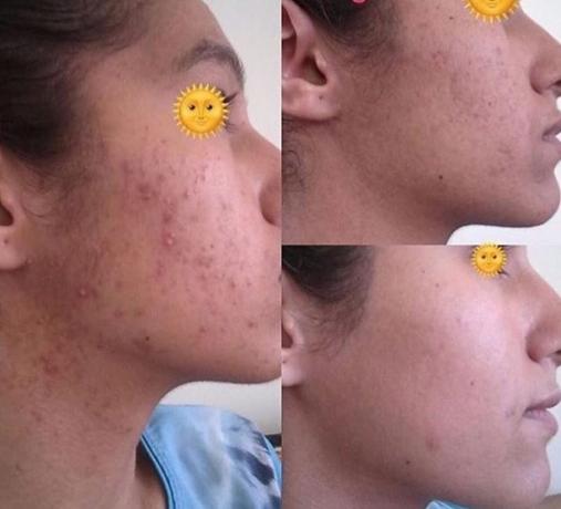enzymes Acne Treatment