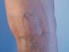 Varicose veins, which "shoots" in the heart
