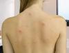 How to get rid of acne on your back