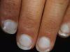 Why whiten fingernails