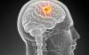 Symptoms of incipient brain tumor