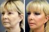Bryl: how to remove sagging cheeks. Cosmetology, exercise and plastic