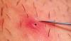 What is the danger in themselves are ingrown hairs