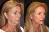 How are ordinary women 50-70 years old who have made a facelift