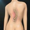 Scoliosis: whether you are at risk?
