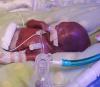 The most premature baby in the world