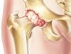 Causes and symptoms of tuberculous arthritis