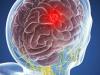 Brain tumor: 5 symptoms that can not be ignored
