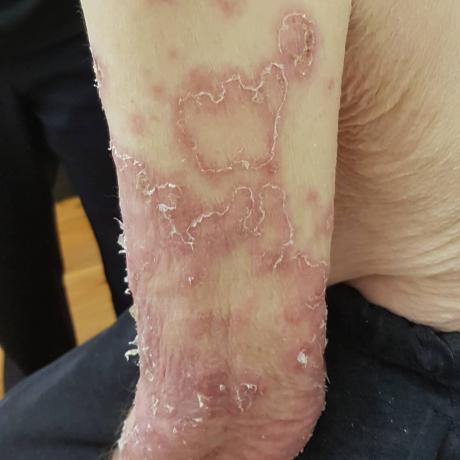 Here is the pellagra. Photos of the patient from the US nursing homes