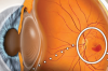 Macular Degeneration: irreversible blindness or have a chance?