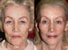 Soviet mask for 20 rubles remove wrinkles, tighten facial contours and smooth out the nasolabial fold. Results after using 1