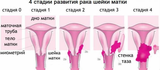 4 stages of cervical cancer