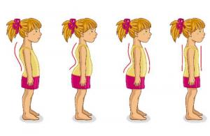 Scoliosis in school children: causes and treatments