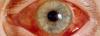 The acute glaucoma: what it is, how to treat?